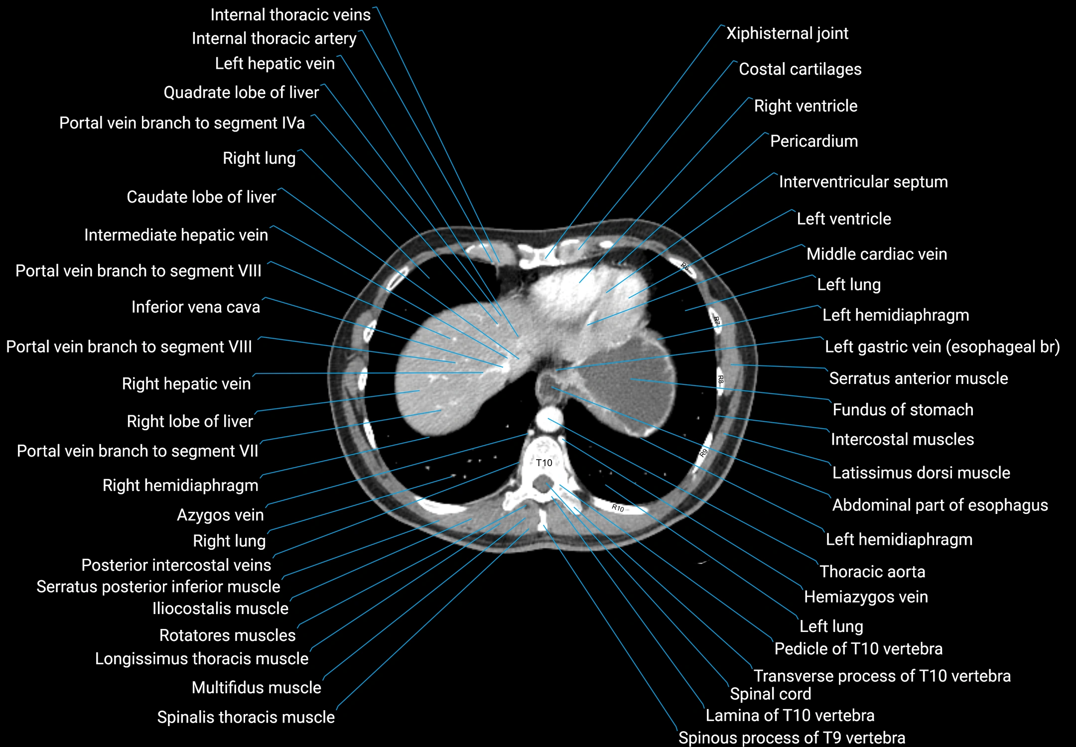 CT male pelvis axial cross sectional anatomy labelled radiology image -00014.webp